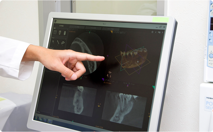 歯科用CTを用いた精度の高い診査・診断